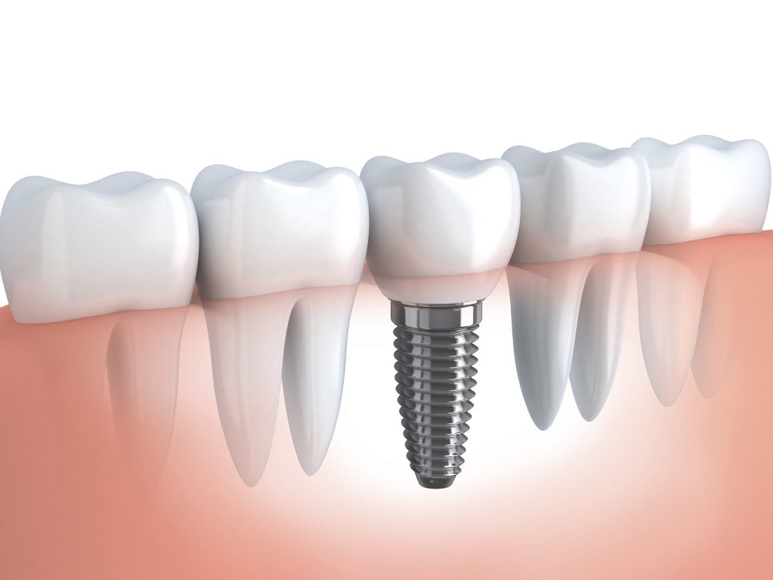 Ilustração de implante dentário